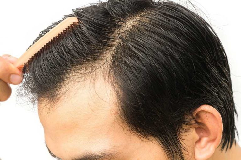 Bizman dies after 12-hour long hair transplant procedure