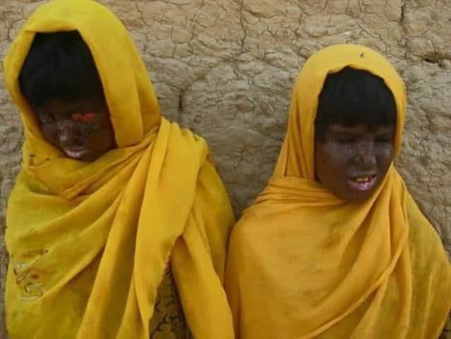 Baloch children affected with nuclear radiation related diseases.